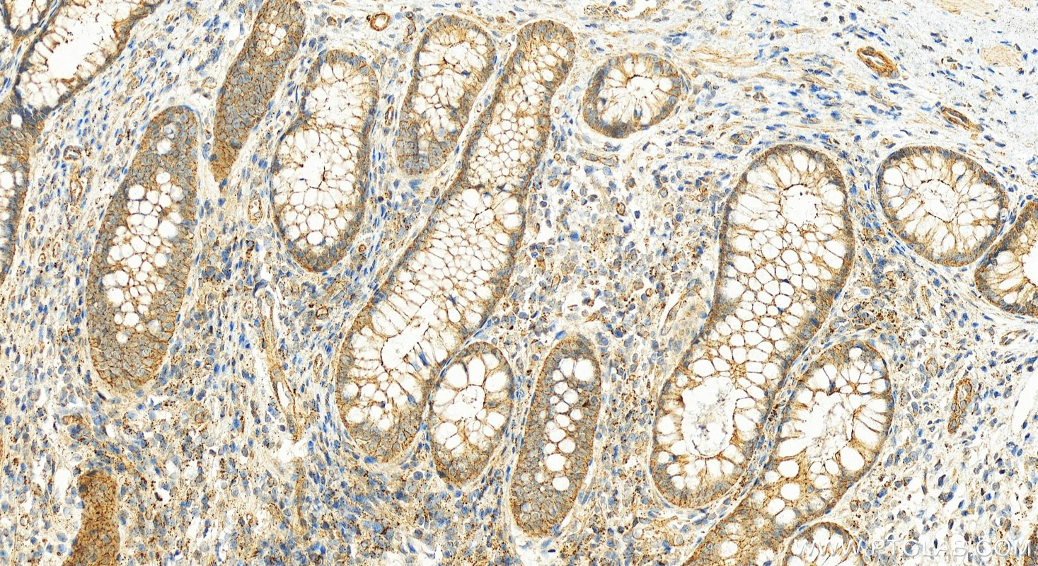 IHC staining of human colon cancer using 25334-1-AP