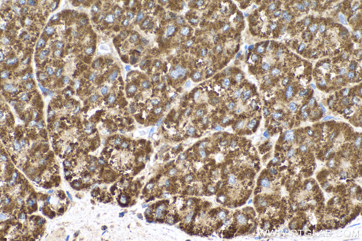 IHC staining of human liver cancer using 60069-1-Ig (same clone as 60069-1-PBS)