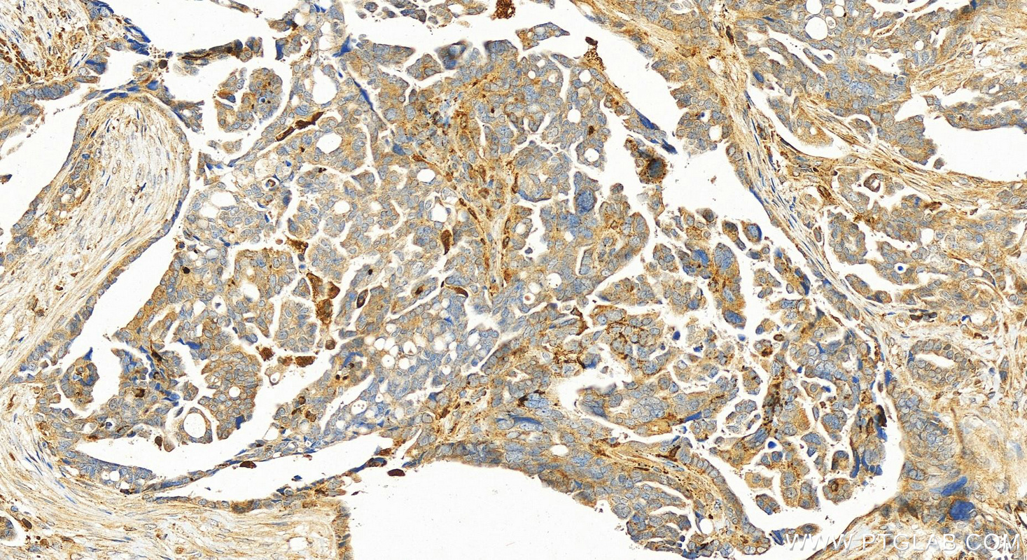 IHC staining of human ovary cancer using 16303-1-AP