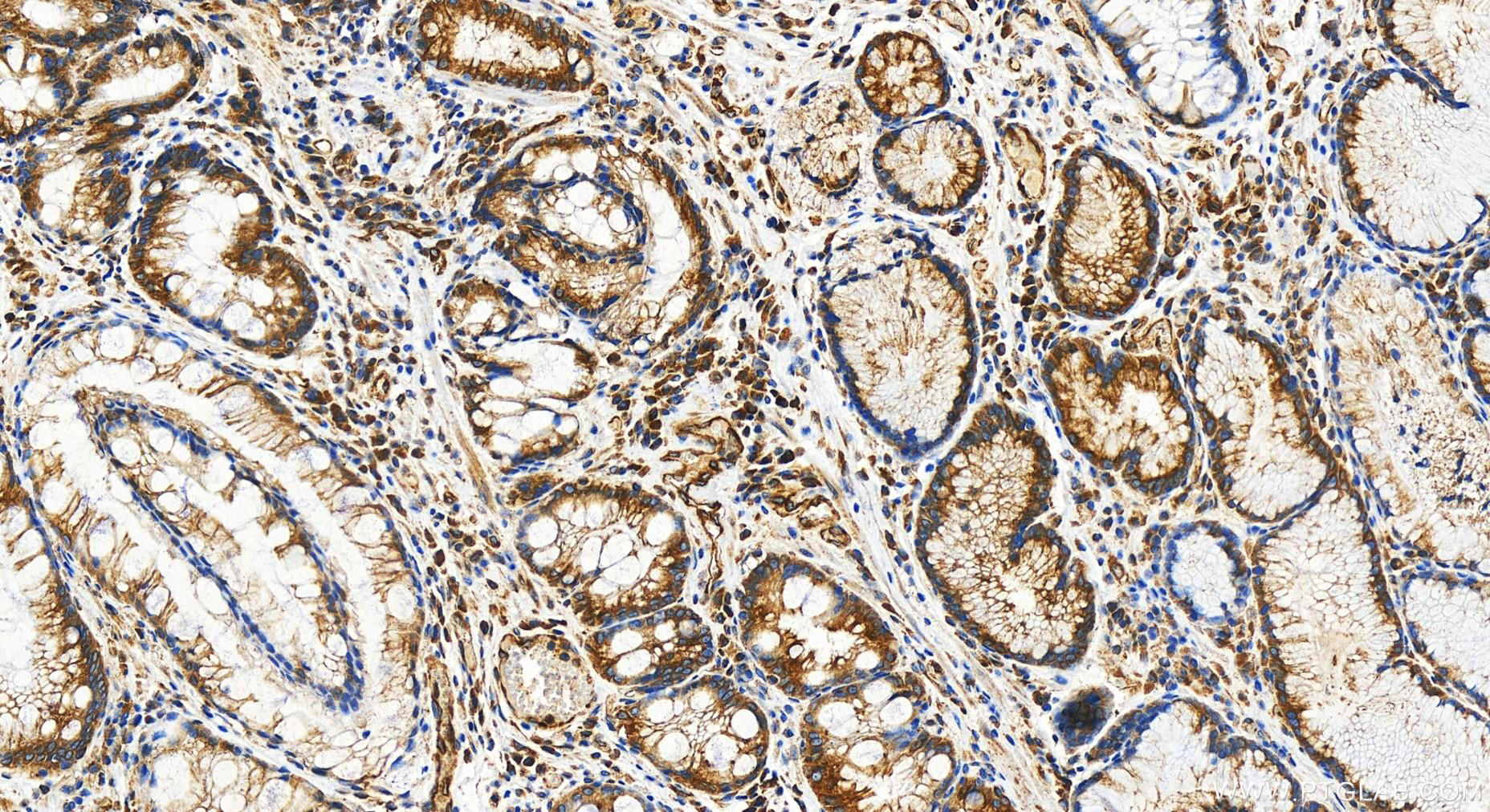 IHC staining of human stomach cancer using 31463-1-AP