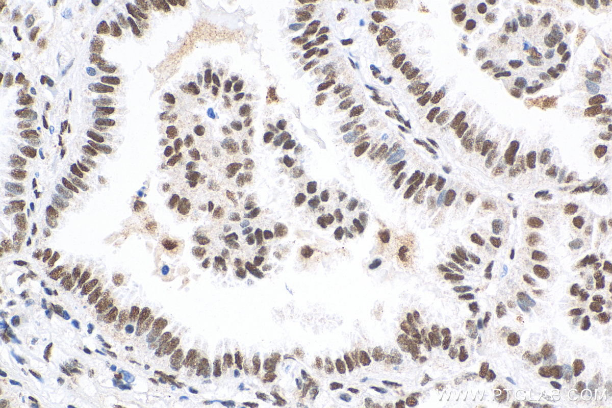 IHC staining of human lung cancer using 51034-1-AP