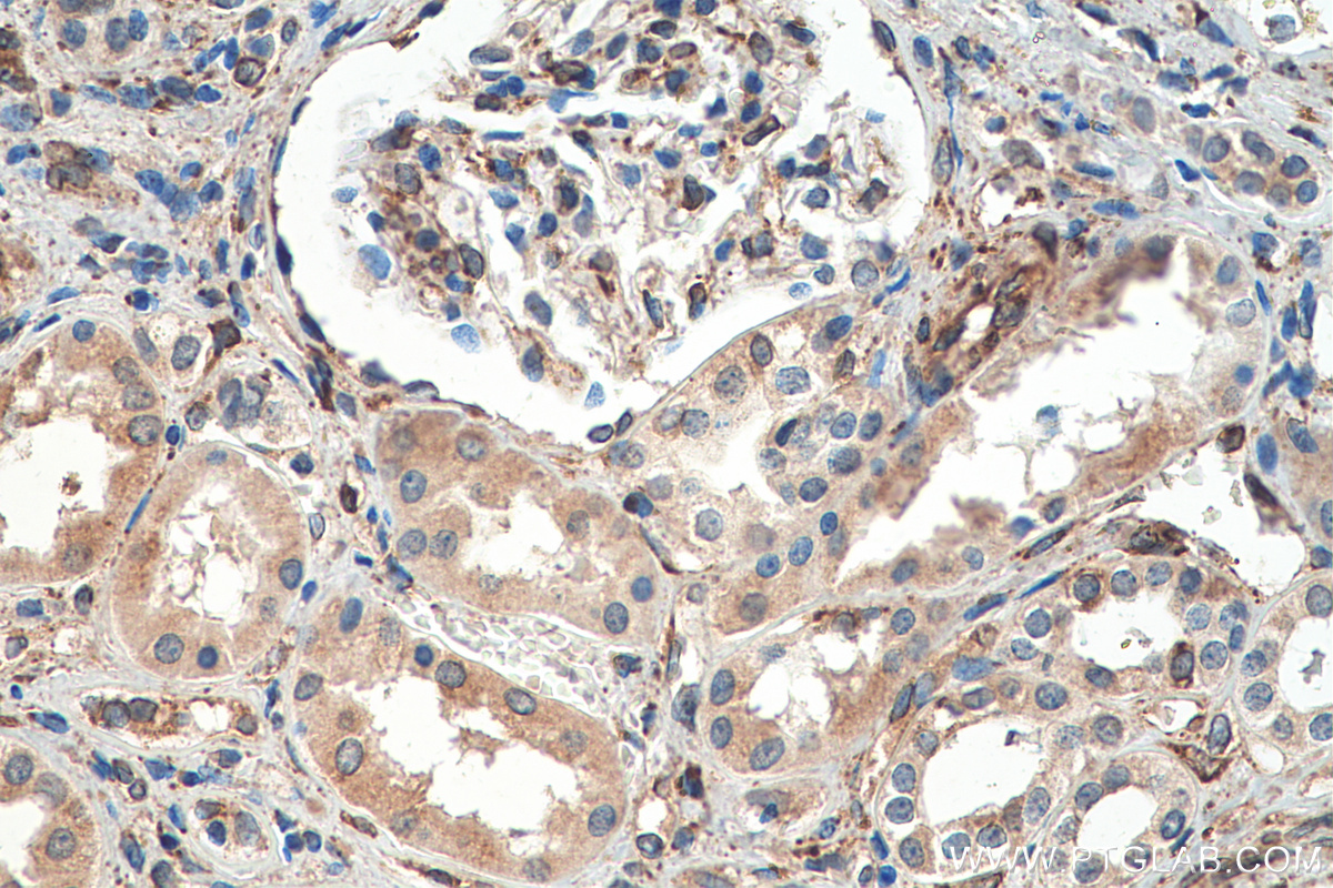 IHC staining of human renal cell carcinoma using 67863-1-Ig (same clone as 67863-1-PBS)