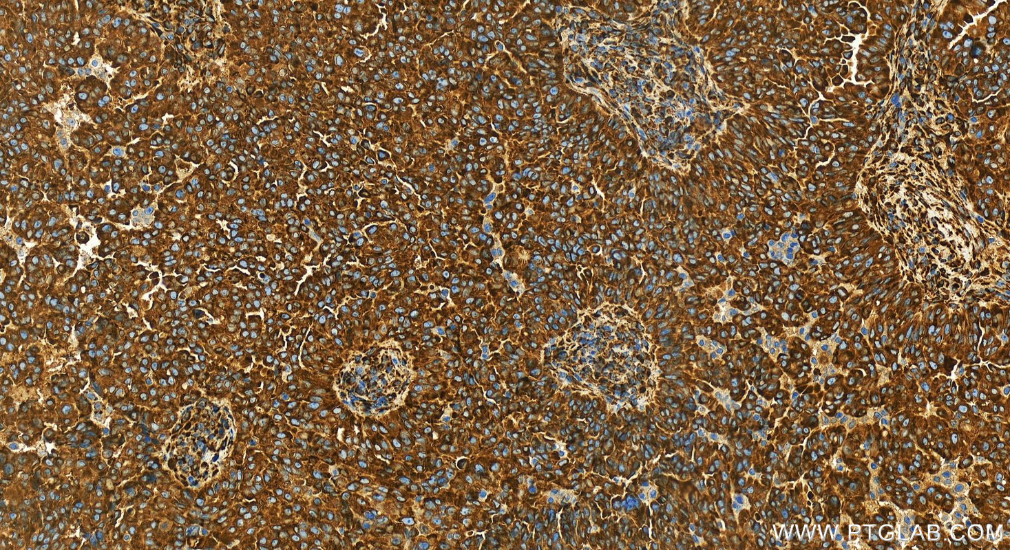 IHC staining of human ovarian  cancer using 83689-3-RR (same clone as 83689-3-PBS)