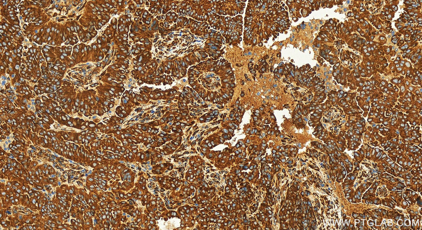 IHC staining of human ovarian  cancer using 83689-4-RR