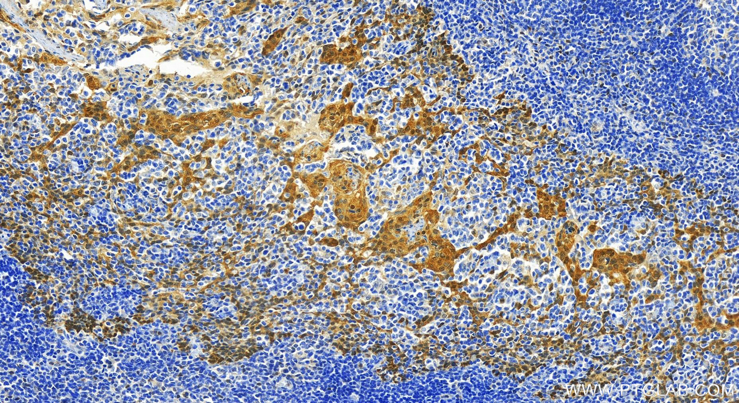 IHC staining of human tonsillitis using 25405-1-AP