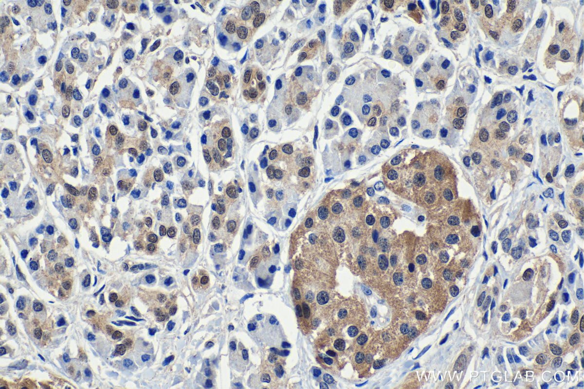 IHC staining of human pancreas cancer using 66183-1-Ig