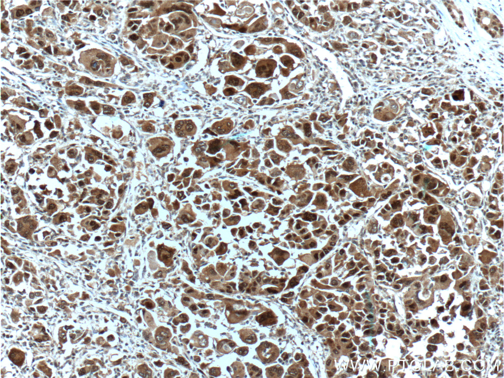 IHC staining of human liver cancer using 66183-1-Ig