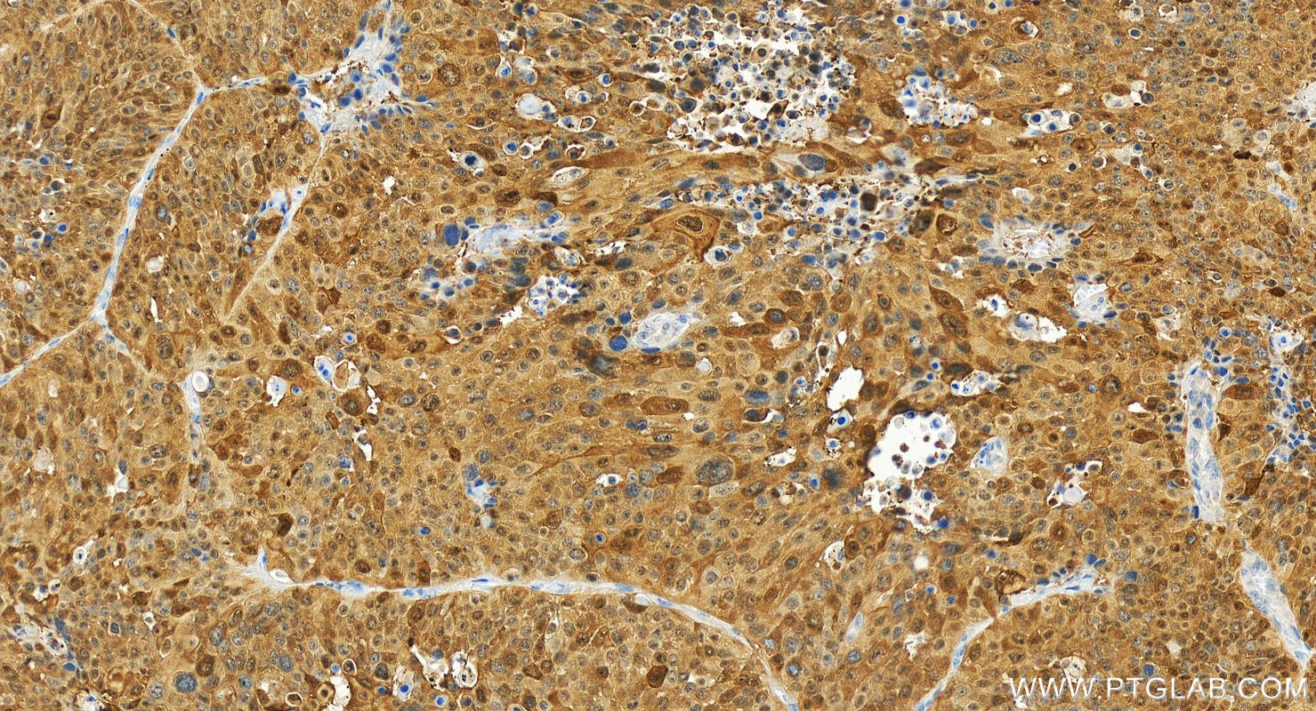 IHC staining of human lung squamous cell carcinoma using 80735-1-RR