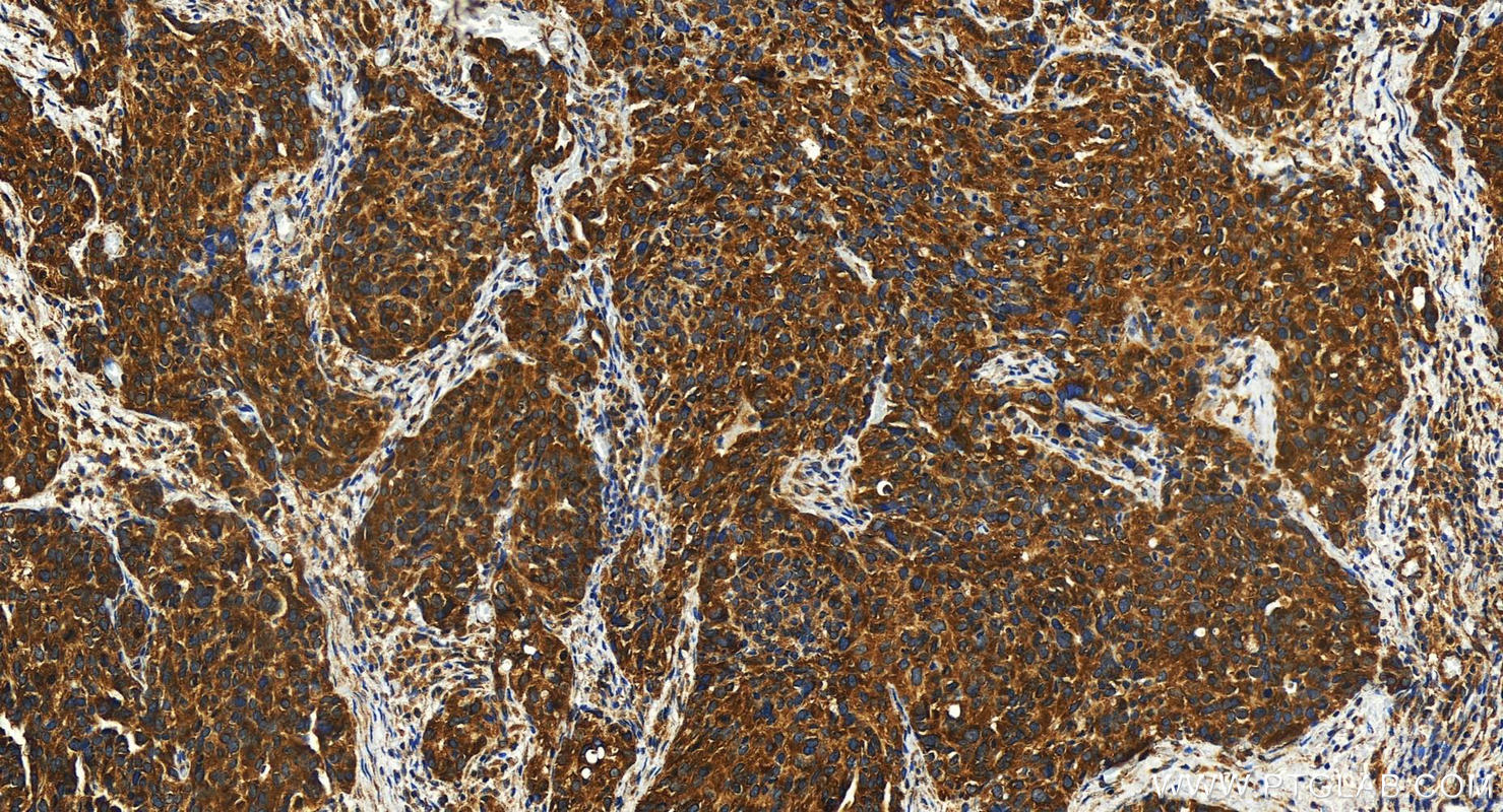 IHC staining of human ovary cancer using 28503-1-AP