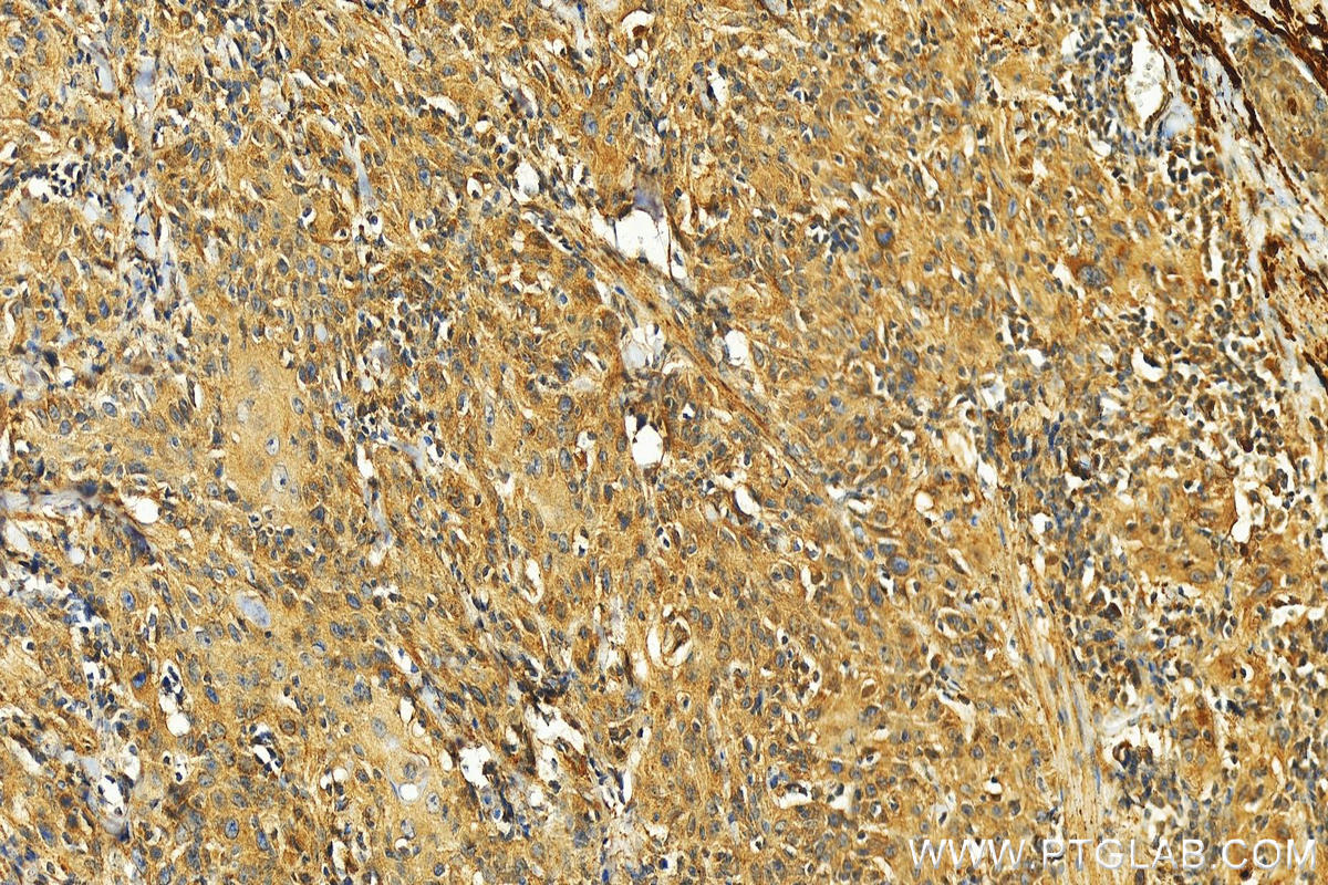 IHC staining of human skin cancer using 29618-1-AP