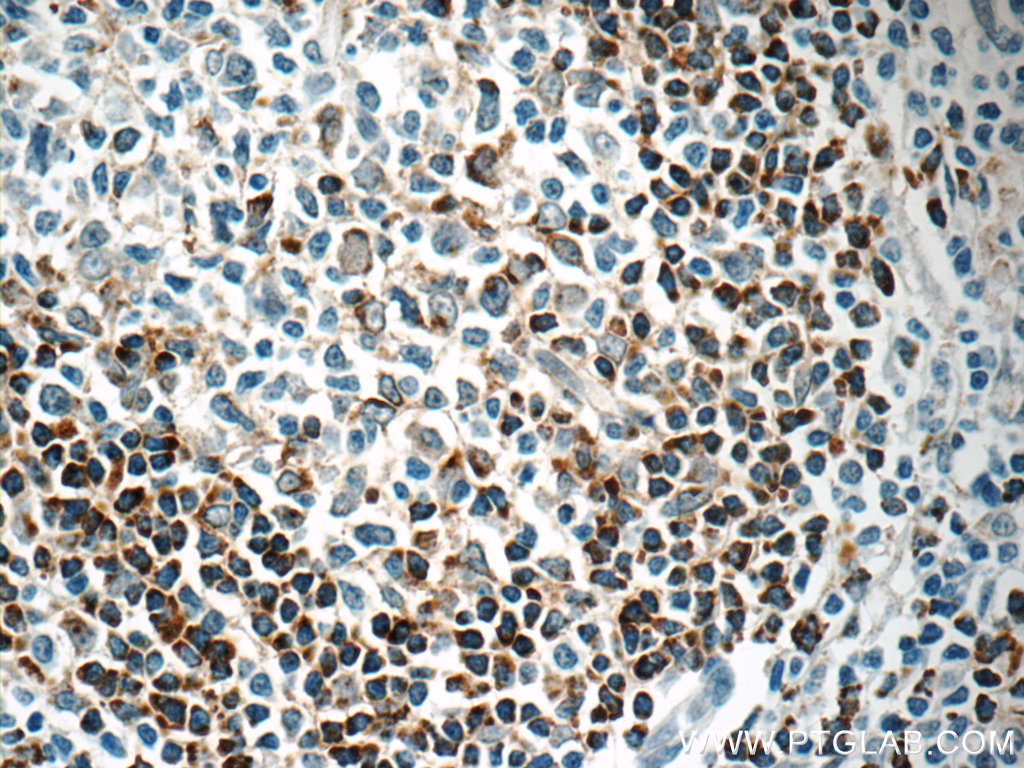 IHC staining of human tonsillitis using 14162-1-AP