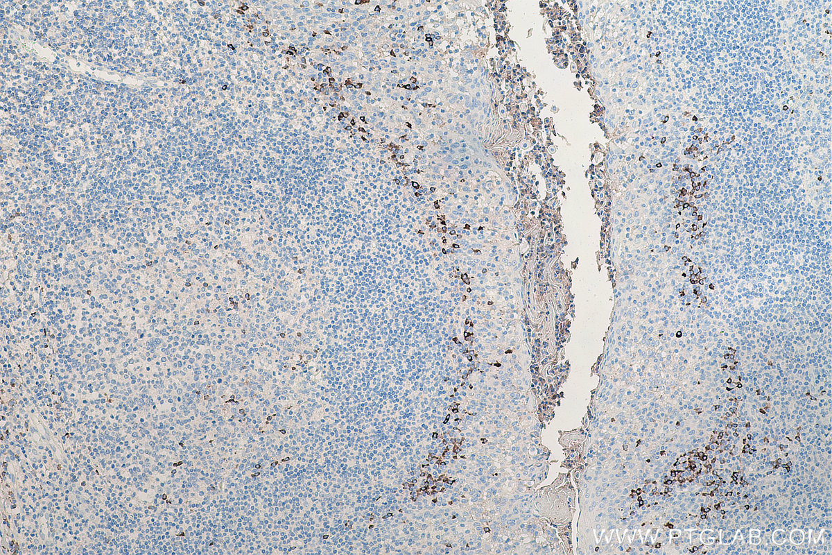 IHC staining of human tonsillitis using 67761-1-Ig (same clone as 67761-1-PBS)