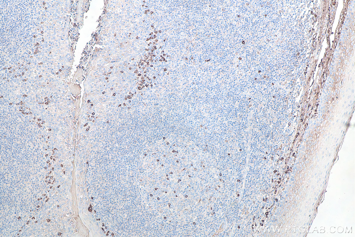 IHC staining of human tonsillitis using 67762-1-Ig