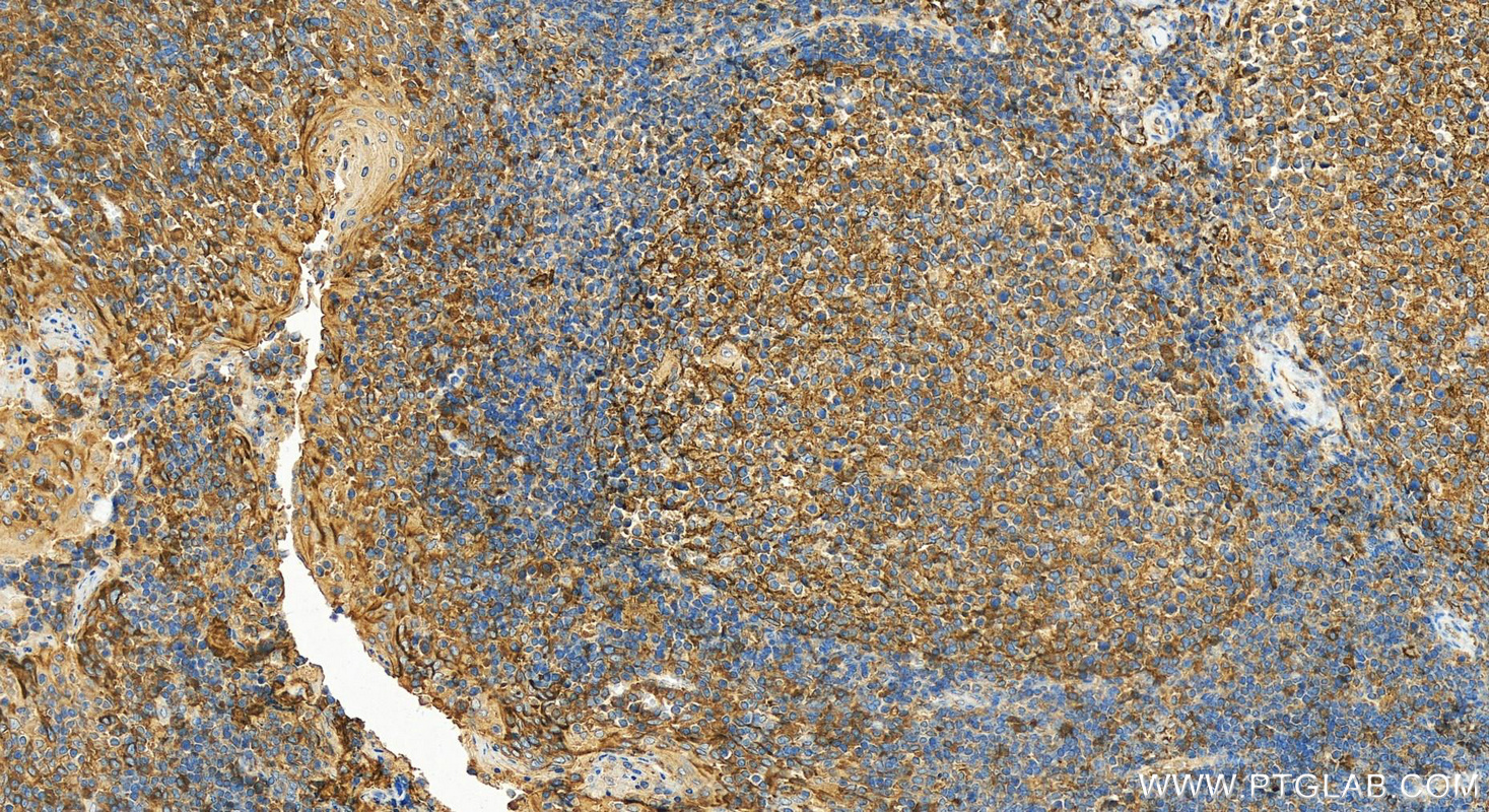 IHC staining of human tonsillitis using 10831-1-AP