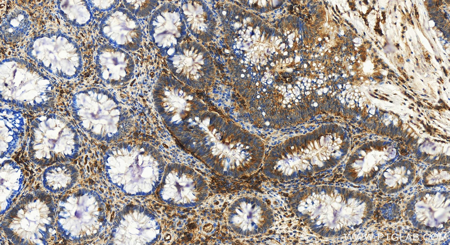 IHC staining of human colon cancer using 15364-1-AP