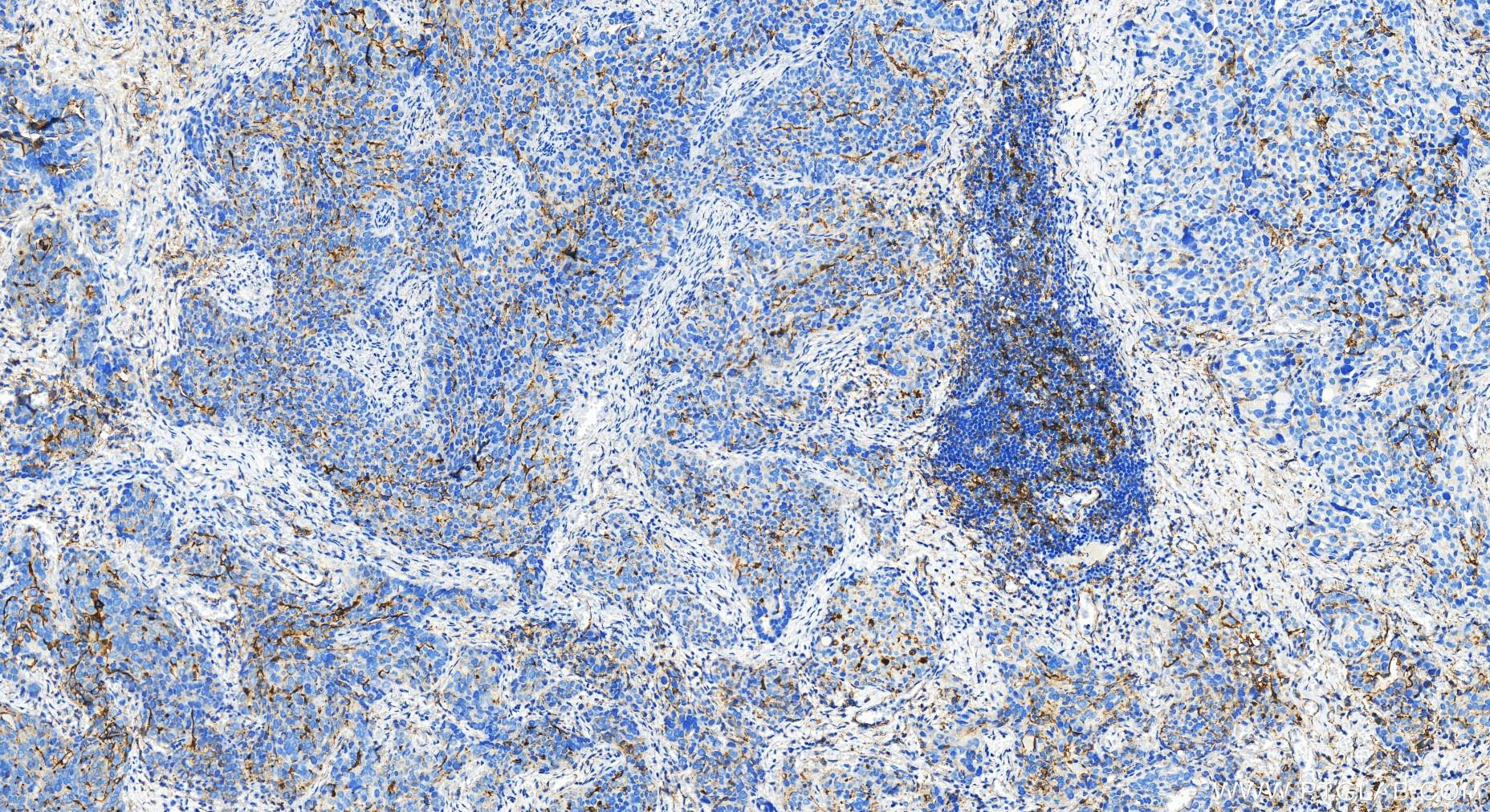 IHC staining of human ovary cancer using 30806-1-AP (same clone as 30806-1-PBS)