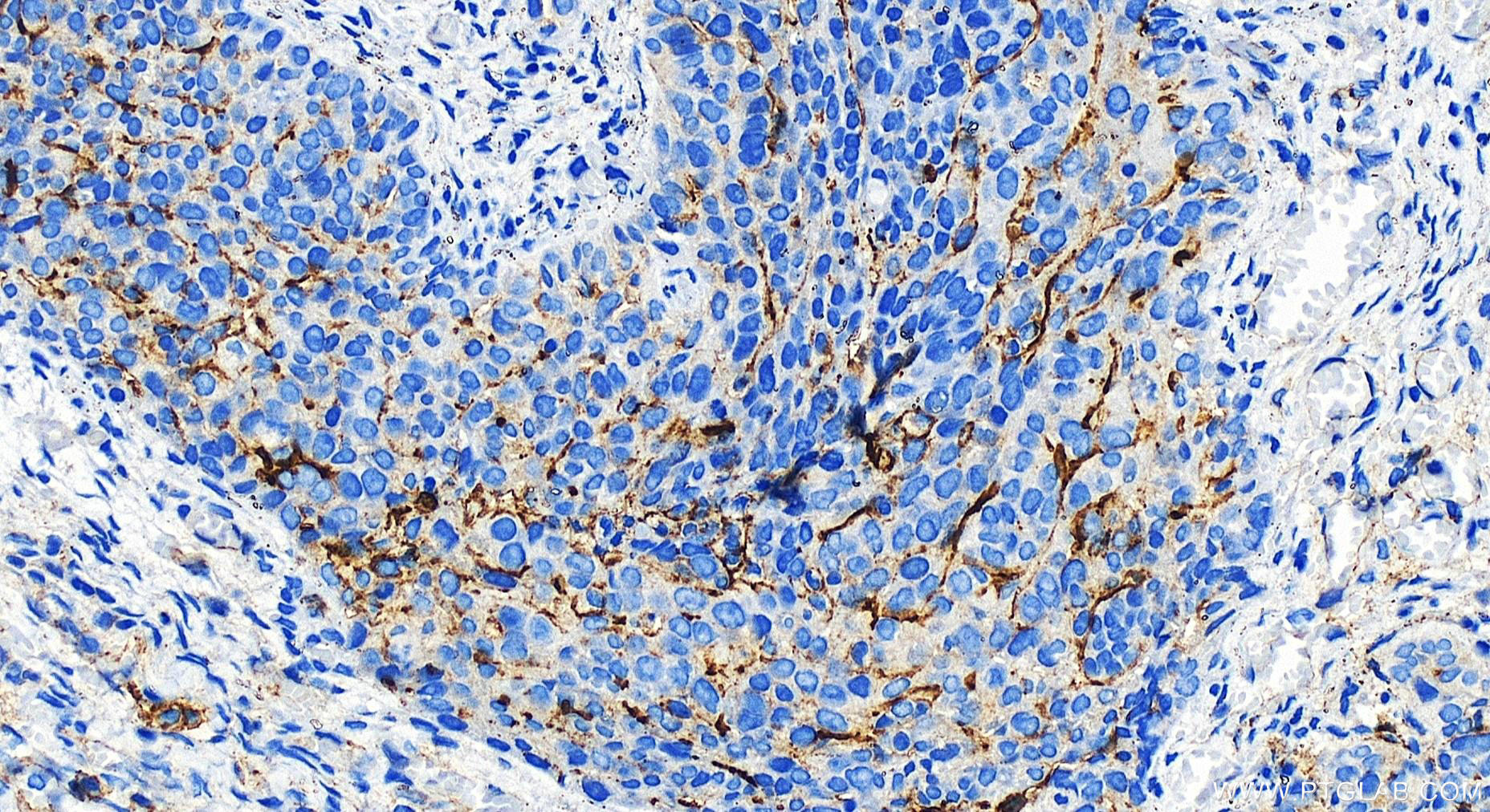 IHC staining of human ovary cancer using 30806-1-AP (same clone as 30806-1-PBS)