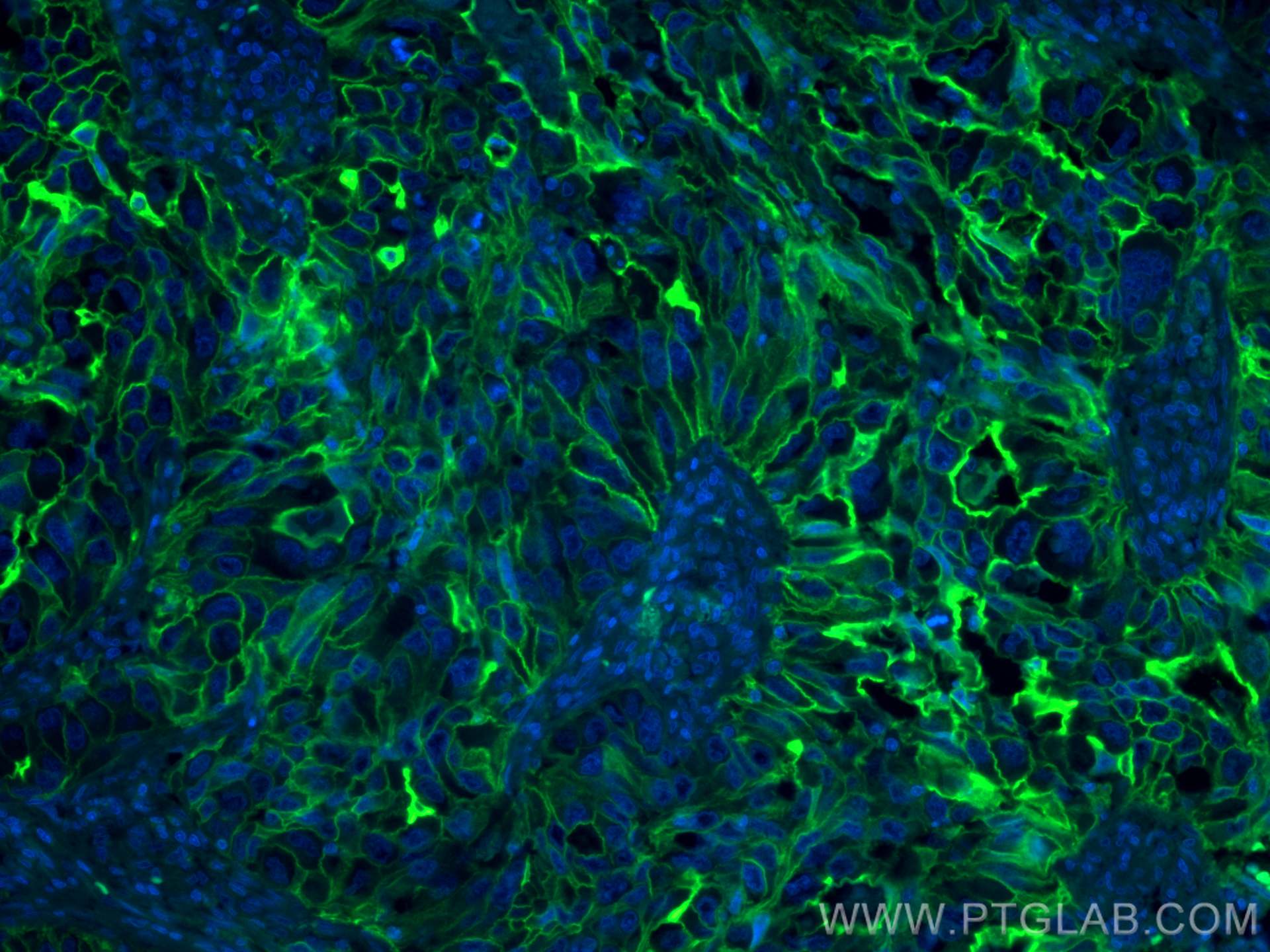 IF Staining of human lung cancer using FITC-60299