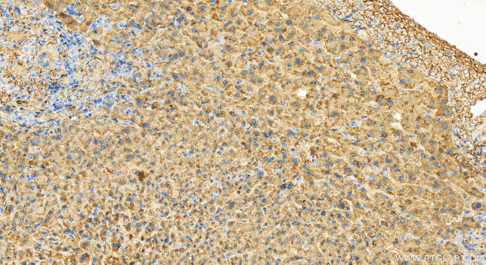 IHC staining of human intrahepatic cholangiocarcinoma using 12332-1-AP