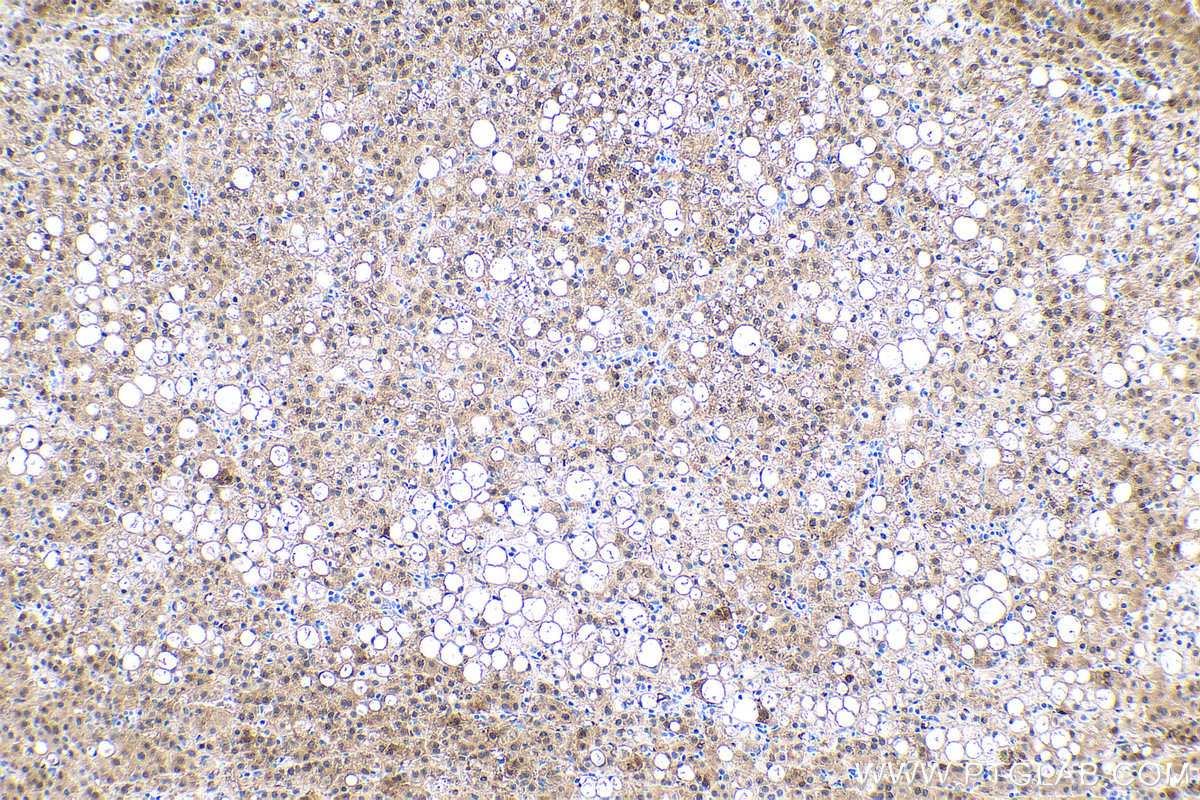 IHC staining of human liver cancer using 66197-1-Ig