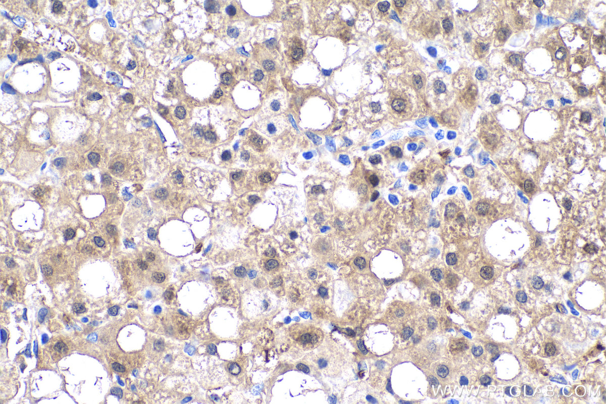 IHC staining of human liver cancer using 66197-1-Ig