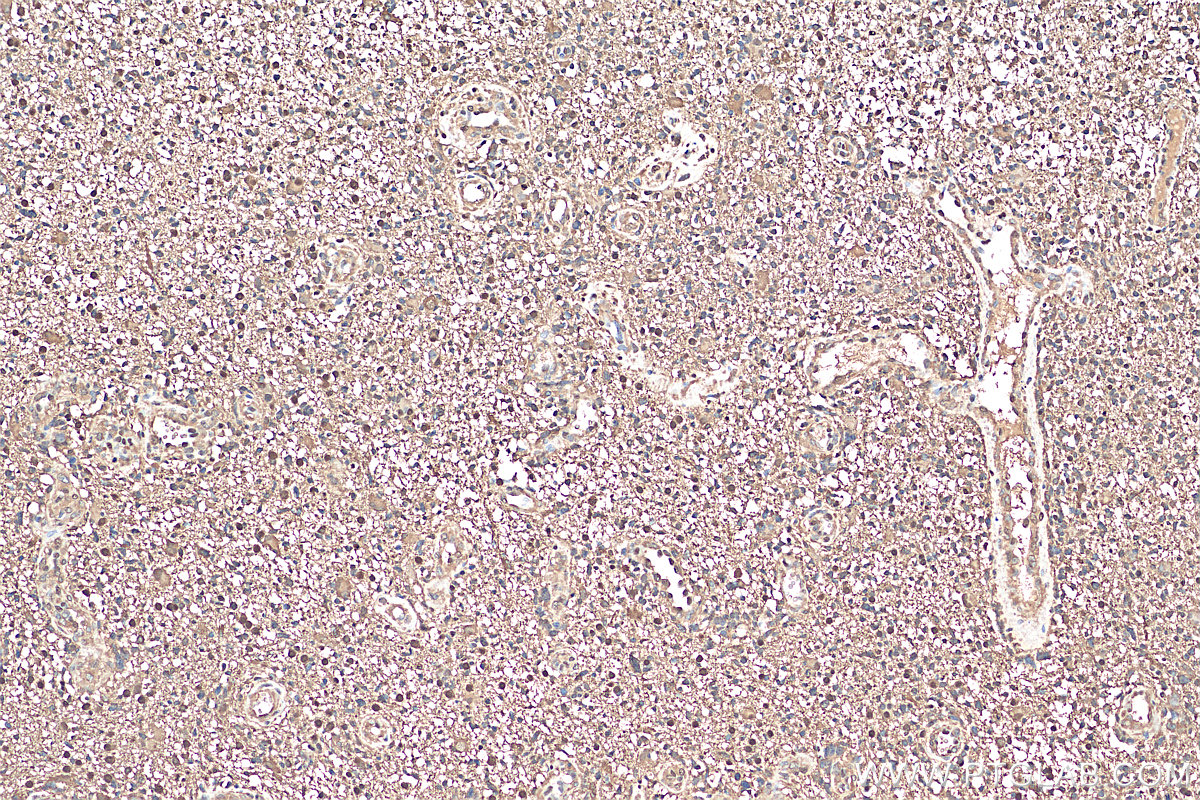 IHC staining of human gliomas using 81176-1-RR