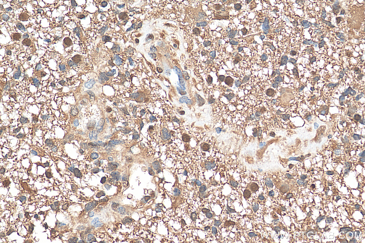 IHC staining of human gliomas using 81176-1-RR