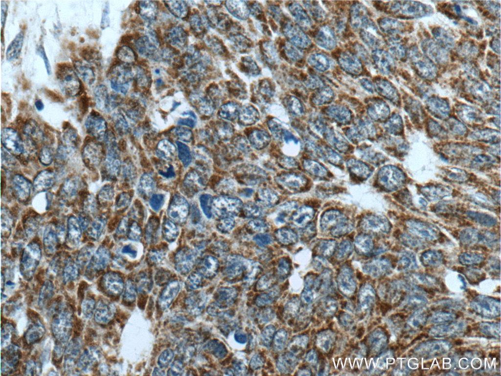 IHC staining of human skin cancer using 25848-1-AP