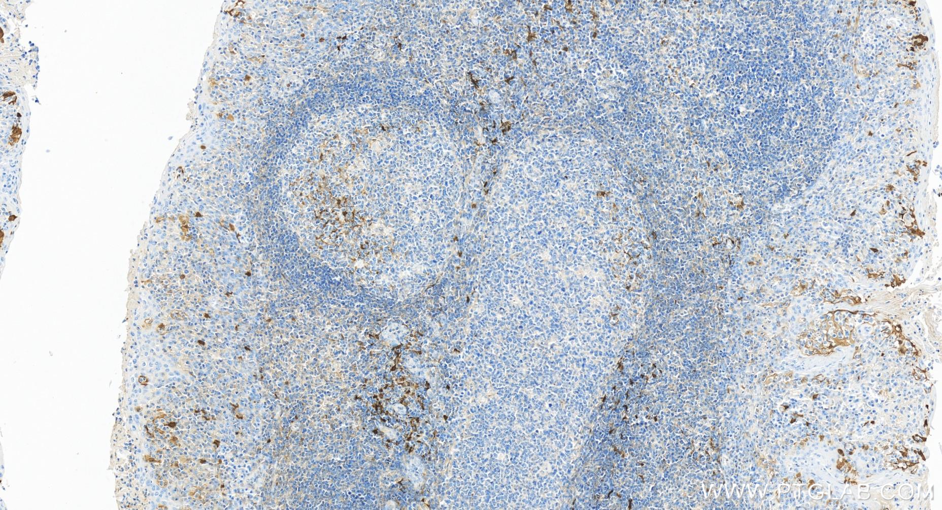 IHC staining of human tonsillitis using 84063-3-RR