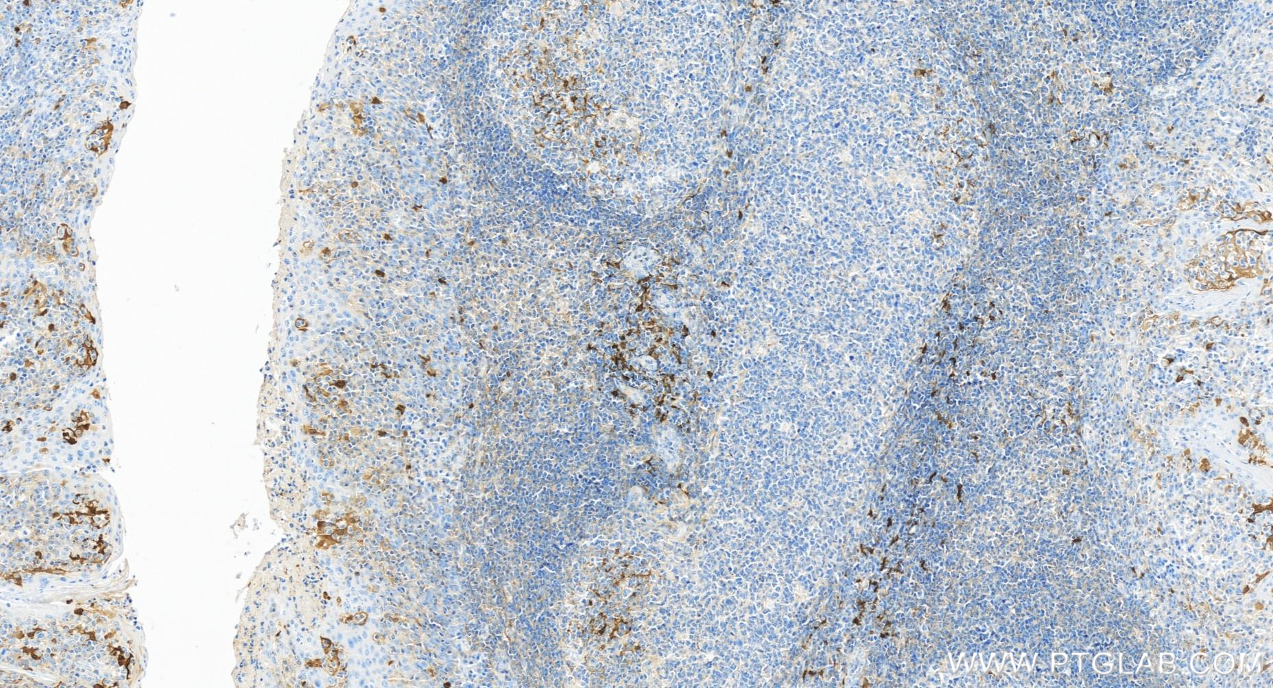 IHC staining of human tonsillitis using 84063-3-RR