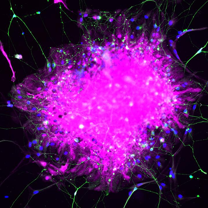 Immunofluorescence analysis of human pluripotent stem cell-derived astrocytes with S100β (15146-1-AP) at 1/200 (Magenta) and neurons with TUJ1 (66375-1-Ig) at 1:500 (Green). The sample was fixed with 4% Paraformaldehyde and permeabilized with 0.3% Triton X-100. Alexa Fluor 488-conjugated goat anti-mouse IgG (1/500) and Alexa Fluor 594-conjugated goat anti-rabbit IgG (1/500) were used as the secondary antibodies. Nuclei were counterstained with DAPI (blue).