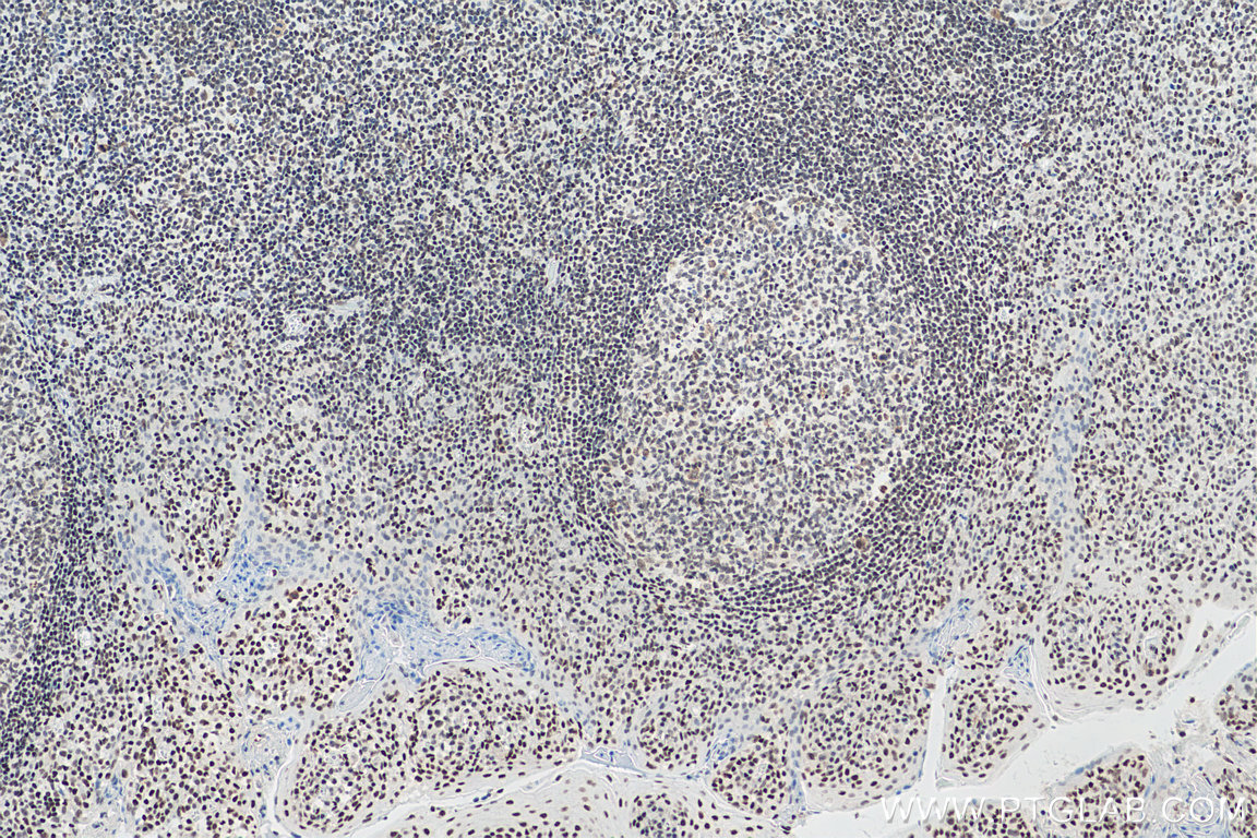 IHC staining of human tonsillitis using 67790-1-Ig (same clone as 67790-1-PBS)