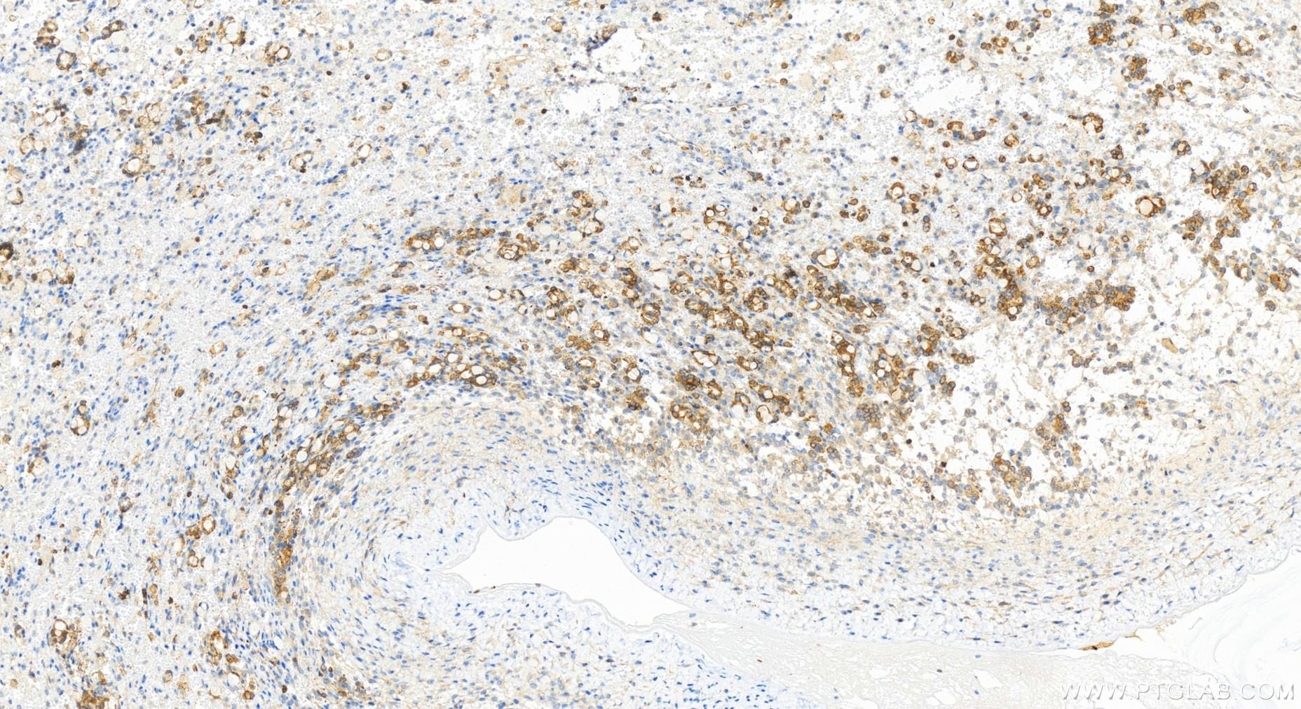 IHC staining of human ovary cancer using 83160-4-RR