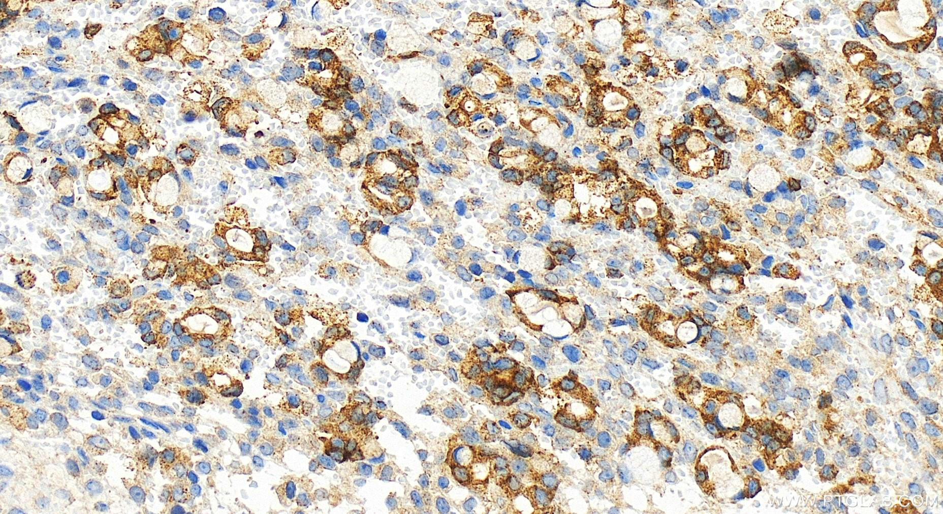 IHC staining of human ovary cancer using 83160-4-RR (same clone as 83160-4-PBS)