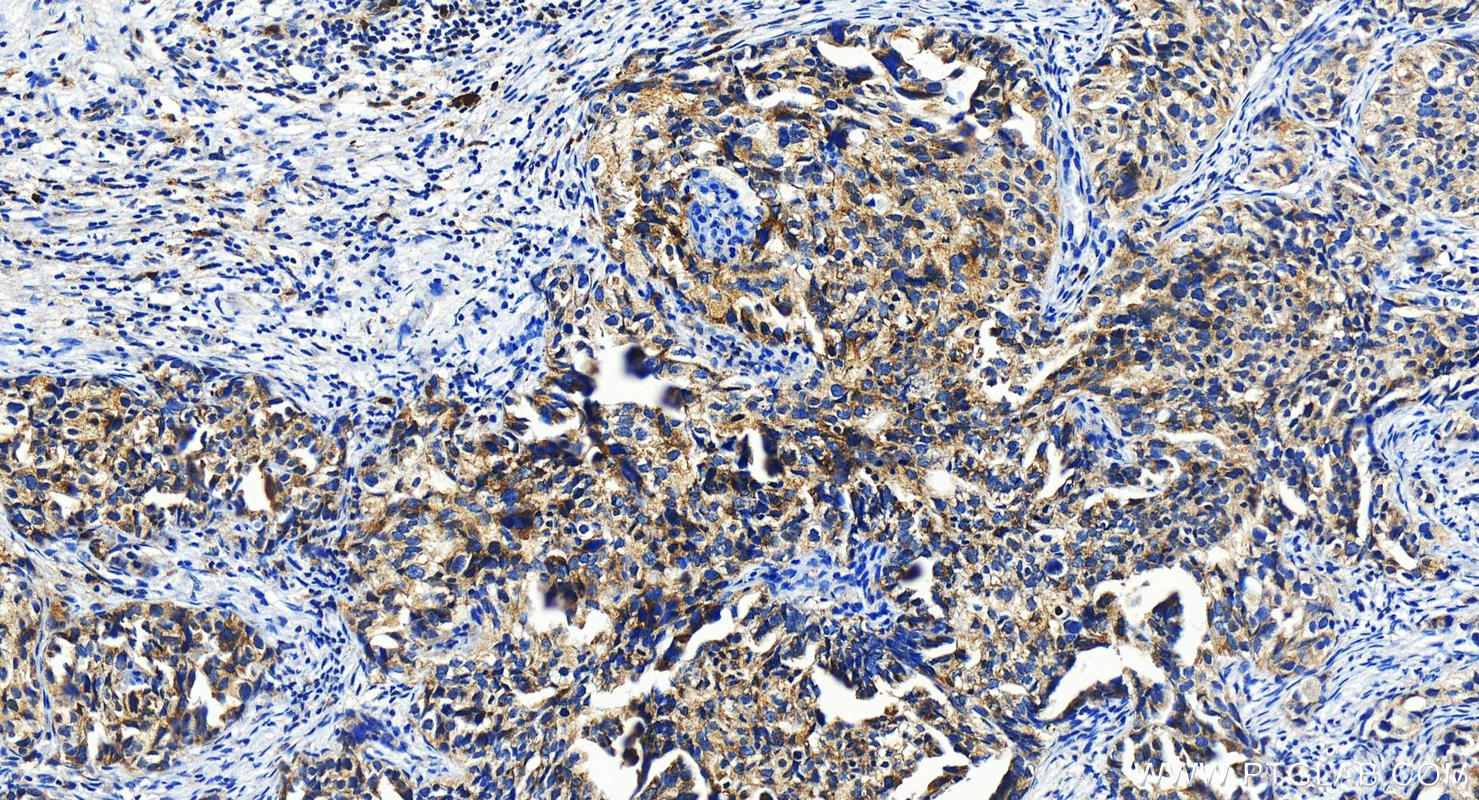 IHC staining of human ovary cancer using 16879-1-AP