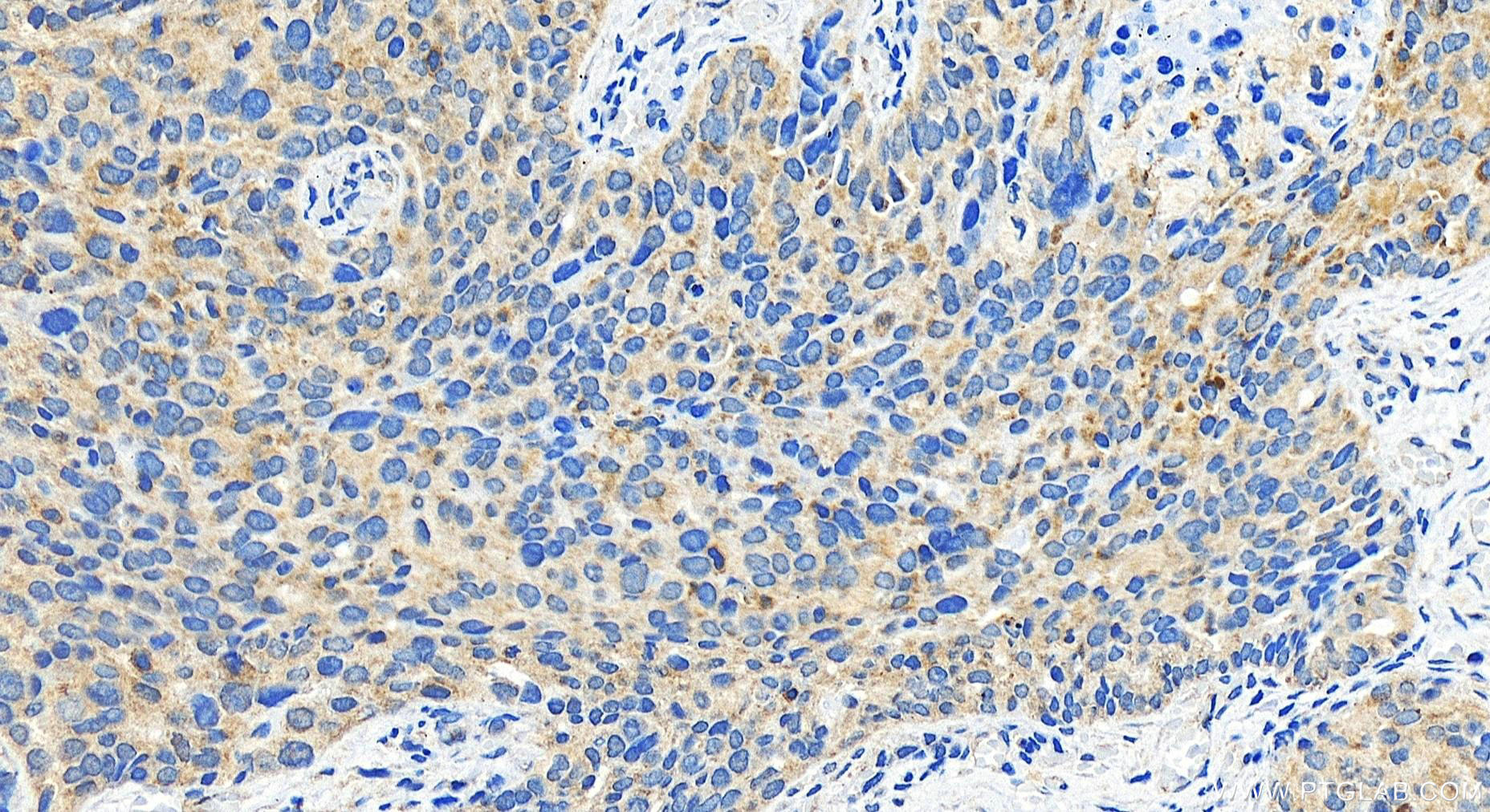 IHC staining of human ovary cancer using 29897-1-AP