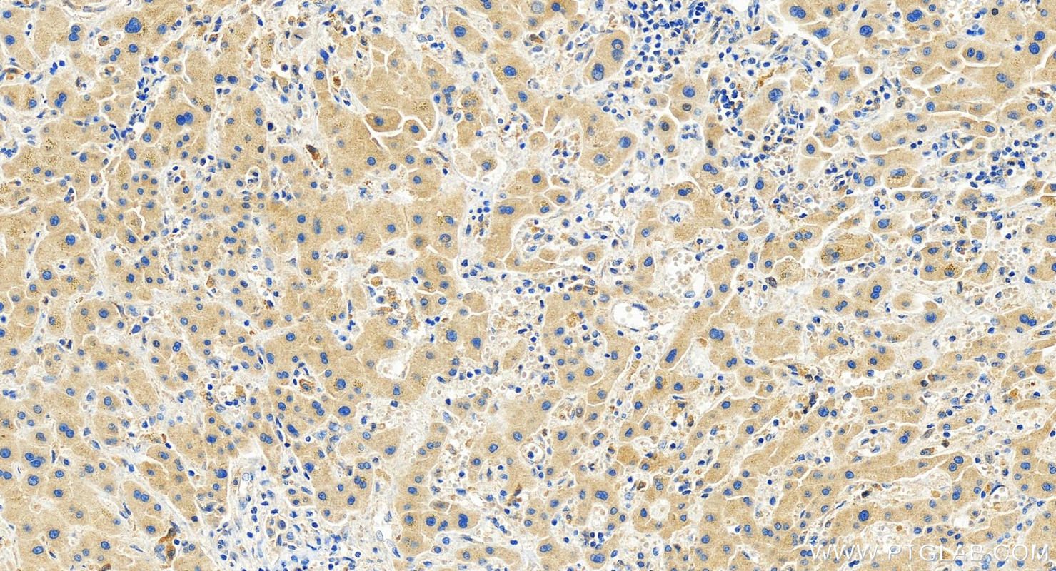 IHC staining of human intrahepatic cholangiocarcinoma using 83423-1-RR