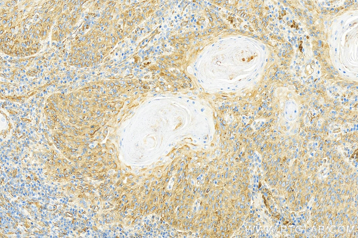 IHC staining of human skin cancer using 11714-1-AP