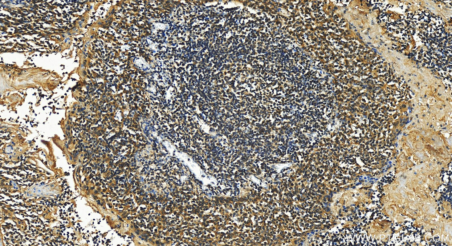 IHC staining of human tonsillitis using 15365-1-AP