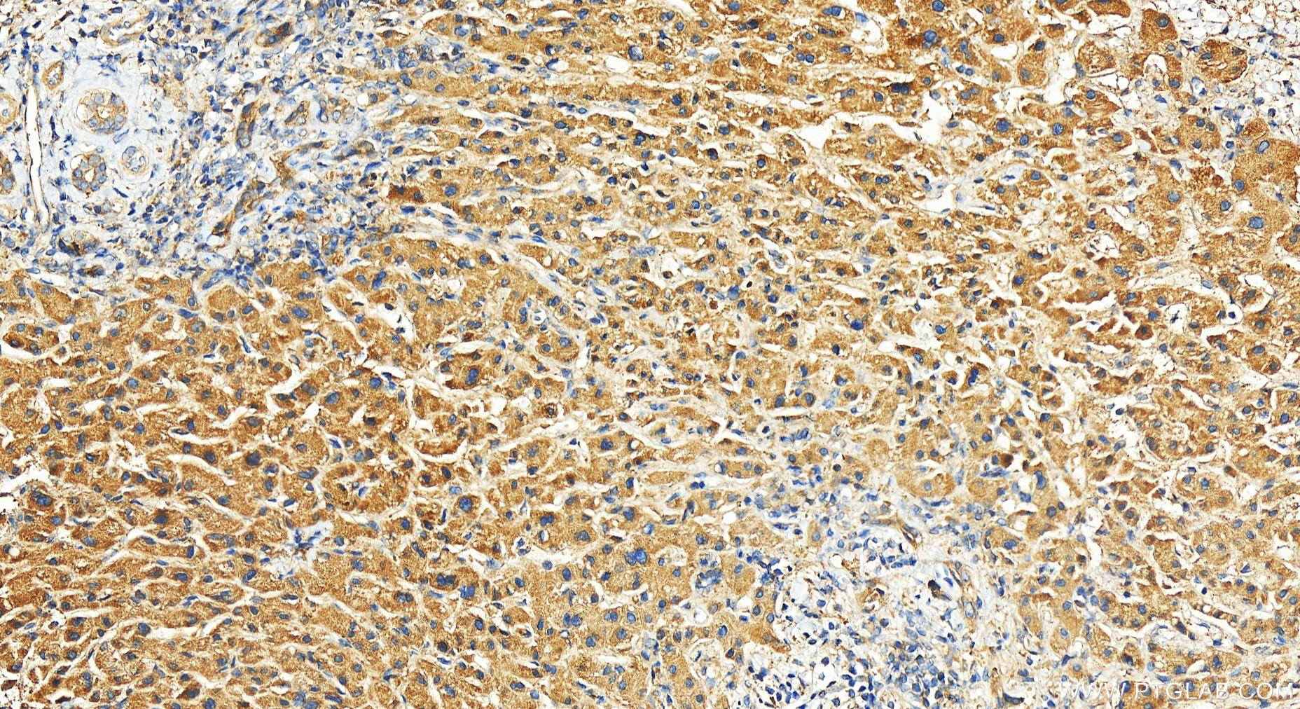 IHC staining of human intrahepatic cholangiocarcinoma using 12939-1-AP