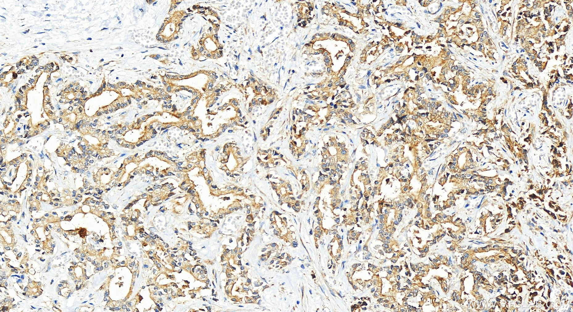 IHC staining of human intrahepatic cholangiocarcinoma using 12939-1-AP