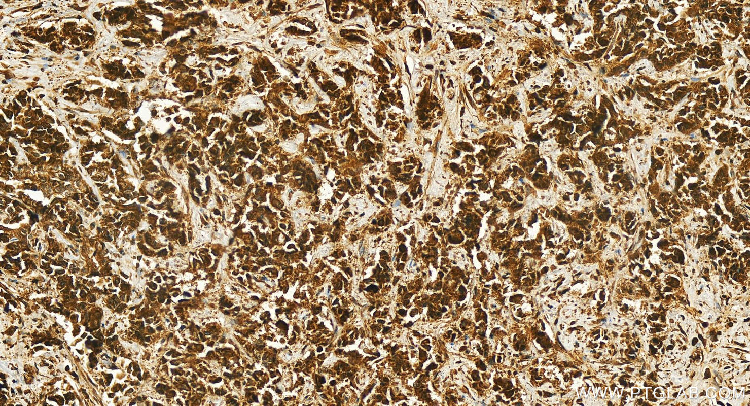 IHC staining of human intrahepatic cholangiocarcinoma using 26952-1-AP