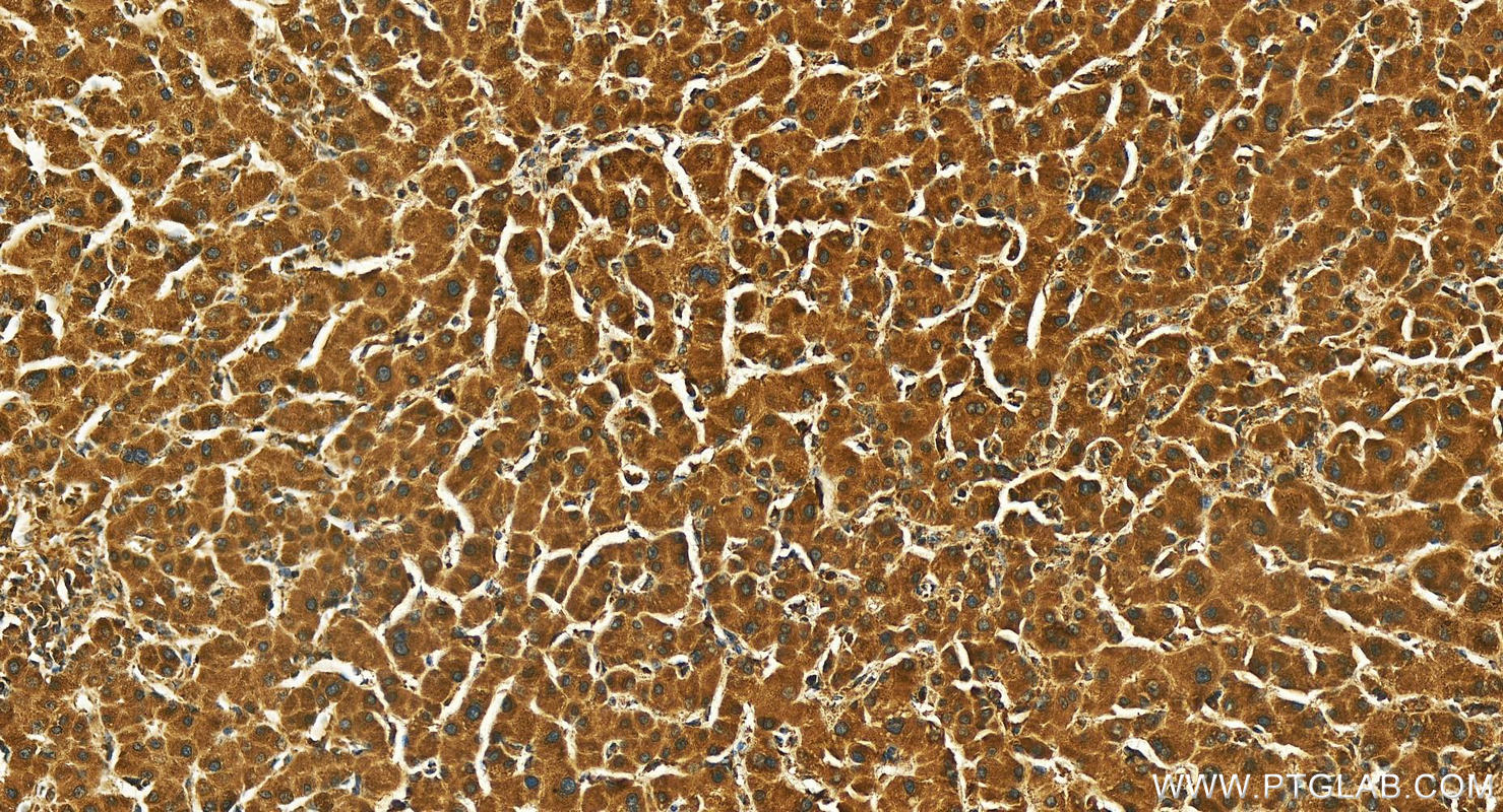 IHC staining of human intrahepatic cholangiocarcinoma using 26952-1-AP