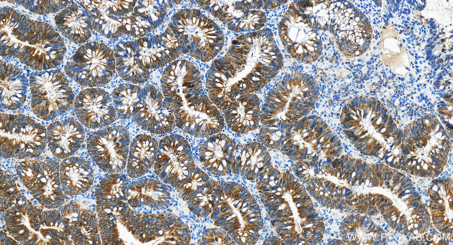 IHC staining of human colon cancer using 81805-1-RR