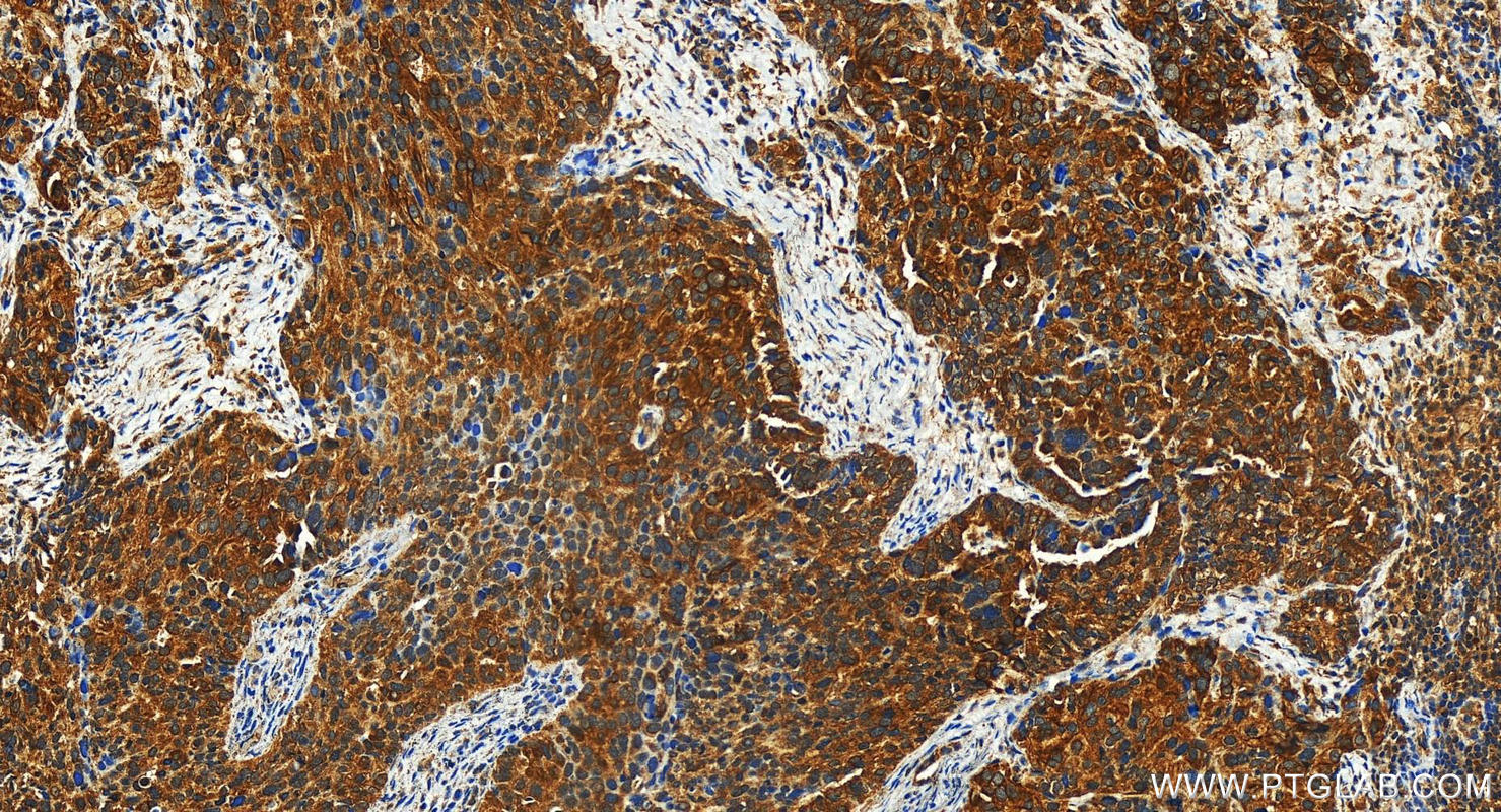 IHC staining of human ovary cancer using 31248-1-AP