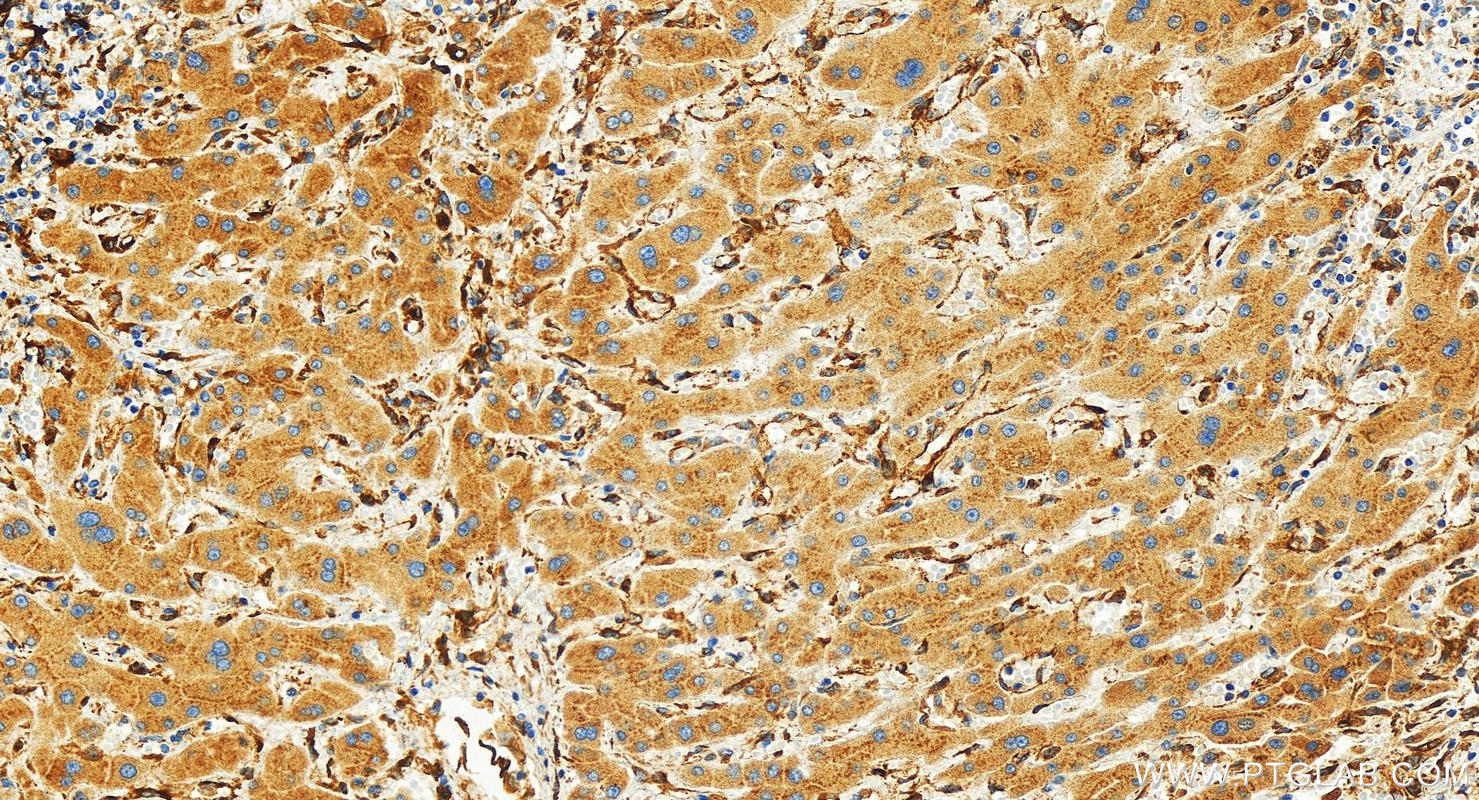 IHC staining of human intrahepatic cholangiocarcinoma using 83200-3-RR