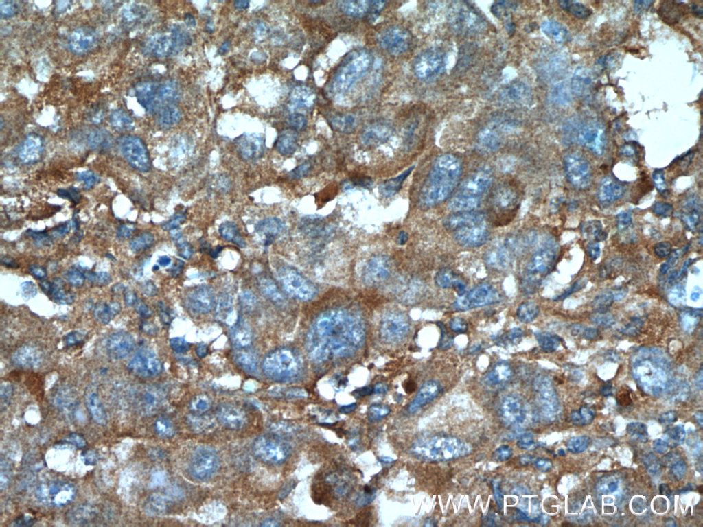 IHC staining of human liver cancer using 19961-1-AP