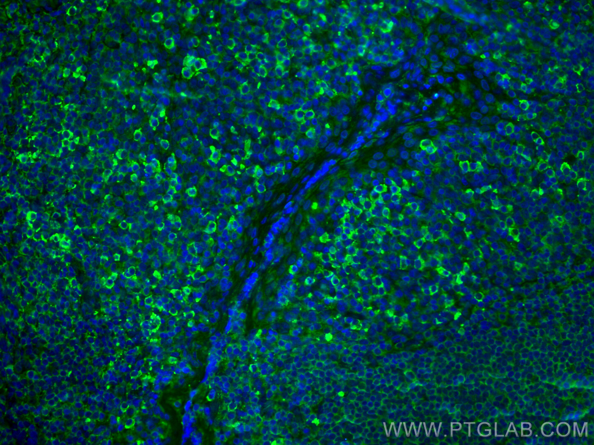 IF Staining of human tonsillitis using 60099-1-Ig (same clone as 60099-1-PBS)