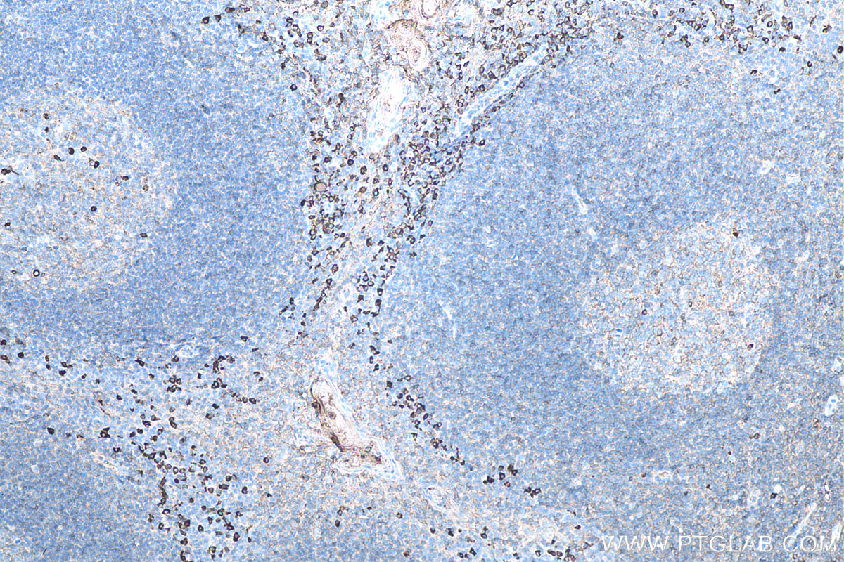 IHC staining of human tonsillitis using 60099-1-Ig (same clone as 60099-1-PBS)