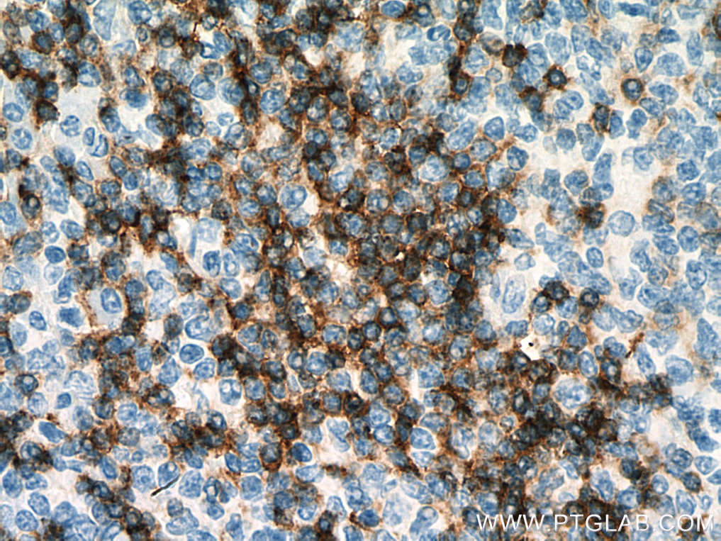IHC staining of human tonsillitis using 67538-1-Ig (same clone as 67538-1-PBS)